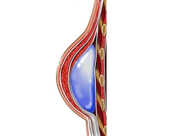 Breast Reconstruction With Implant