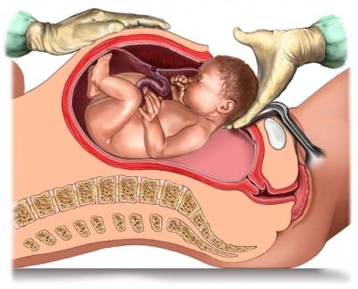 Cesarean Delivery