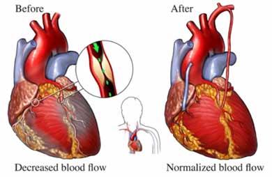 Coronary Artery Bypass Surgery