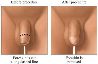 Circumcision