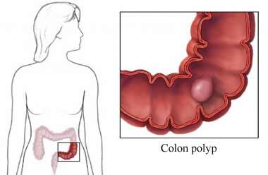 A Colon Polyp
