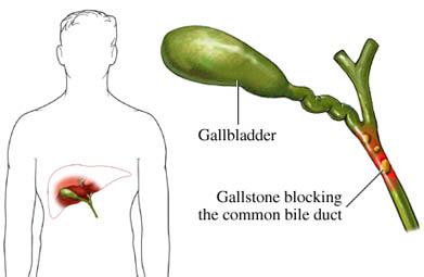 Gallstones