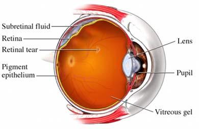 Detached Retina