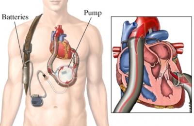 Left Ventricular Assist Device