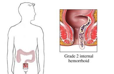 Grade 2 Hemorrhoid