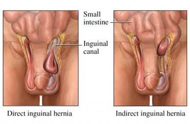 Inguinal Hernias