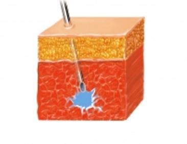 Intramuscular Injection