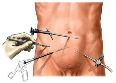 Laparoscopic Instruments Being Placed in the Abdomen