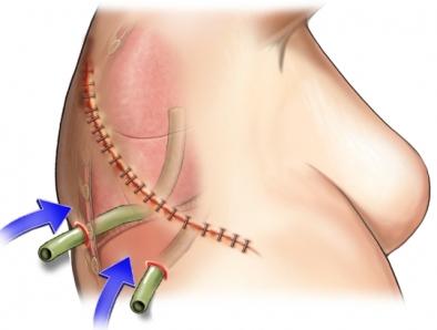 Drainage Tubes and Incision After Thoracotomy