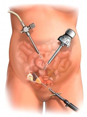 Laparoscopic Ovary Removal