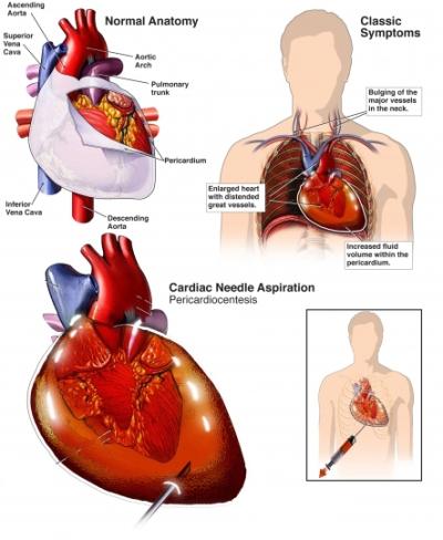 Pericardiocentesis