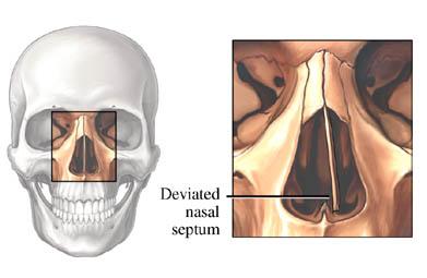 Deviated Septum
