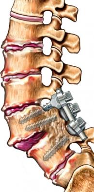 Healed Lumbar Fusion