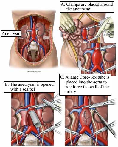 Repair of Abdominal Aortic Aneurysm