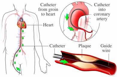 Insertion of Catheter with Guide Wire