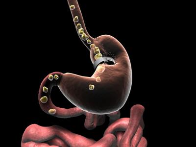 Vertical Banded Gastroplasty