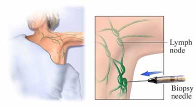 Lymph Node Biopsy